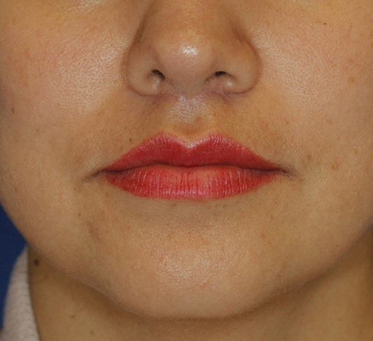 Subnasal Lip Lift After