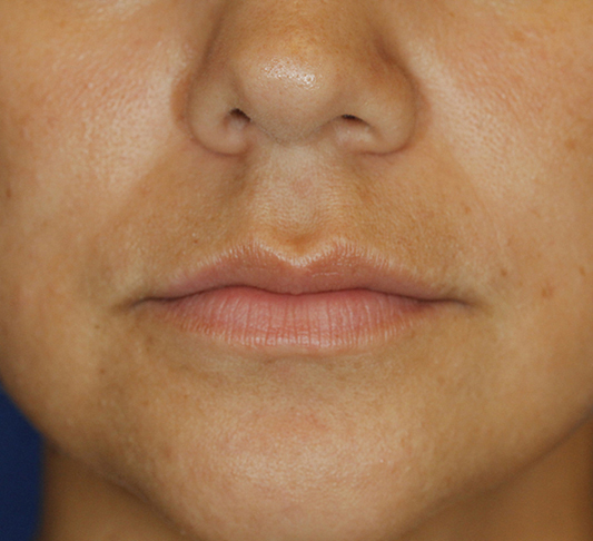 Subnasal Lip Lift Before