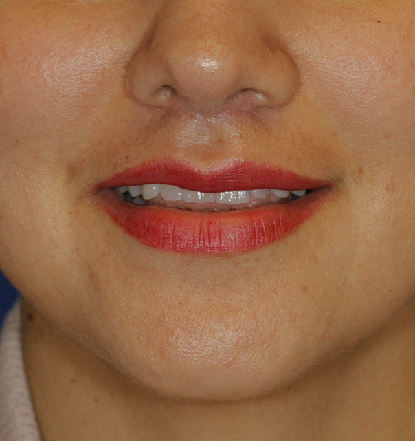 Subnasal Lip Lift After Smiling