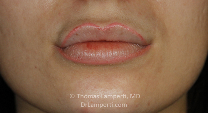 After Lip Filler Frontal