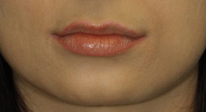 Before Lip Filler Frontal