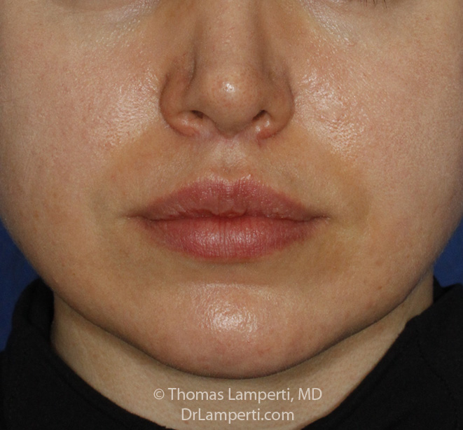 Upper Lip Lift After