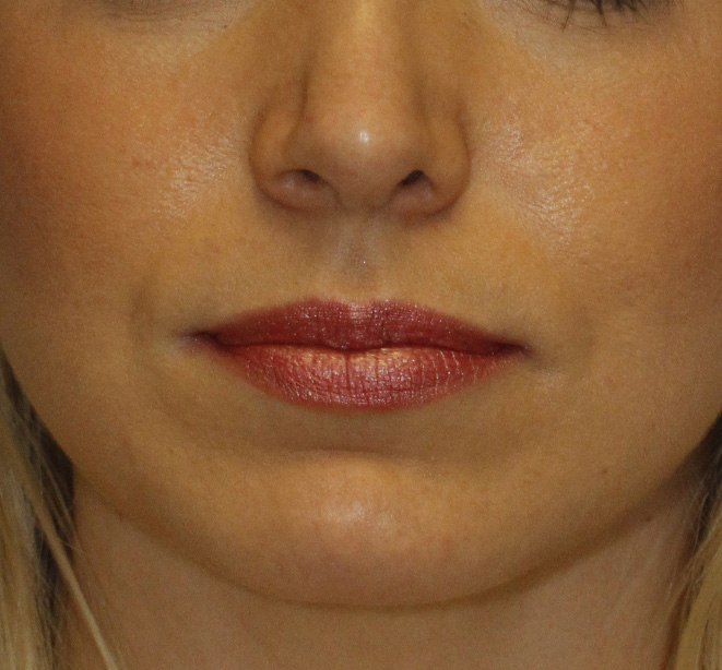 Upper Lip Lift Before