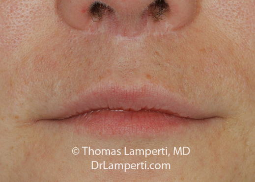 Subnasal Lip Lift After