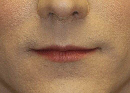 Subnasal Lip Lift Before