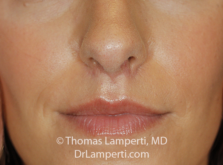 Subnasal Lip Lift After detail