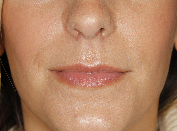 Subnasal Lip Lift Before Frontal