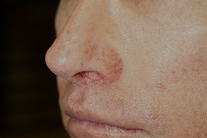 After Lip Lift Left Oblique