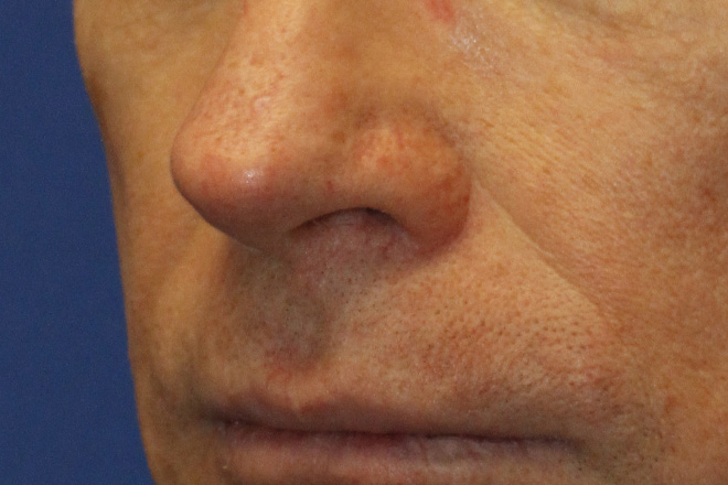 Before Lip Lift Left Oblique