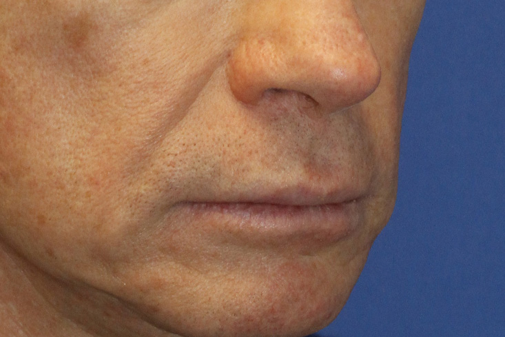 Before Lip Lift Right Oblique