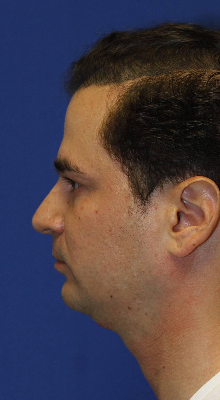 Neck Liposuction Before L Profile