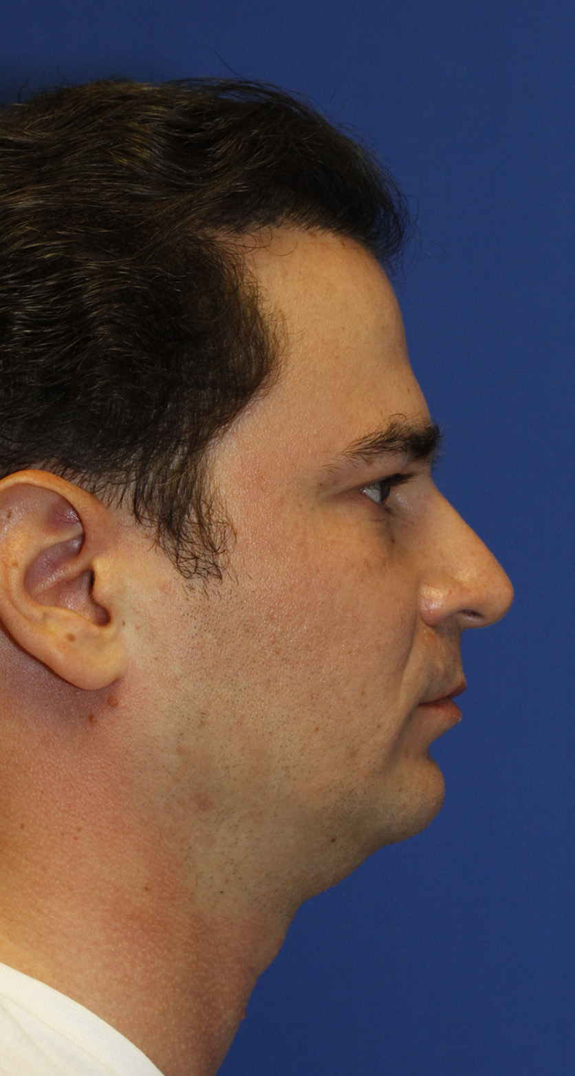 Neck Liposuction Before R Profile