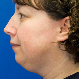 Before neck liposuction photo