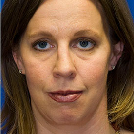 After Neck Liposuction