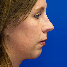 After neck liposuction