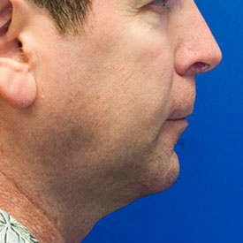 After neck liposuction