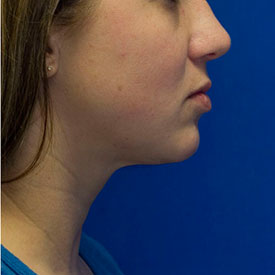 After neck liposuction