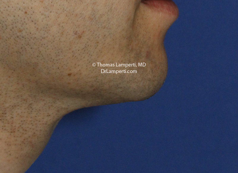 Neck Liposuction R Profile After