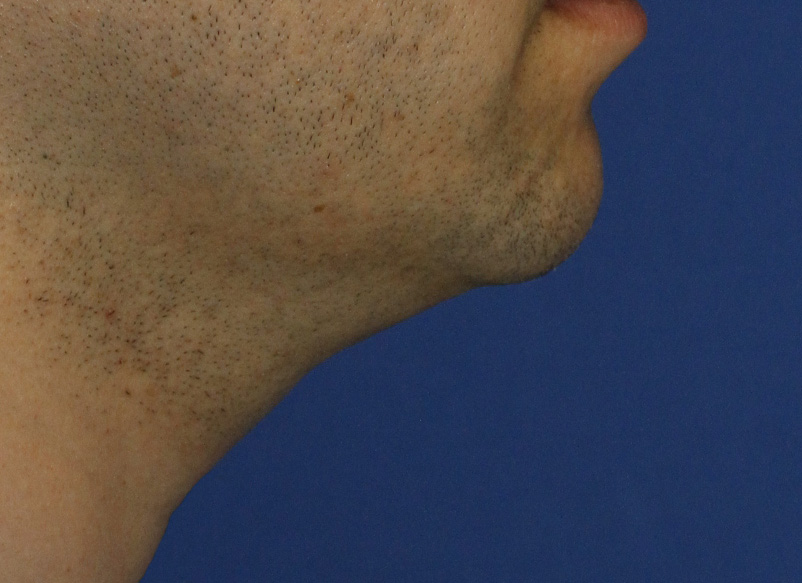 Neck Liposuction R Profile Before