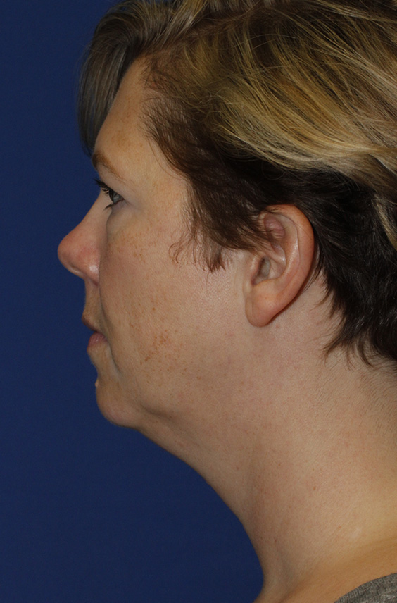 Neck Liposuction L Profile Before