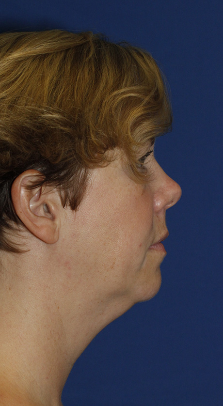 Neck Liposuction R Profile Before