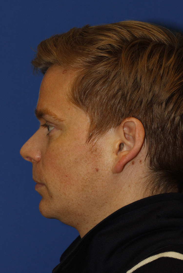 Lobuloplasty Before L Profile