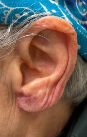 L Earlobe Reduction After