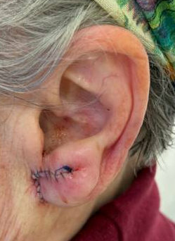 L Earlobe Reduction Sutures