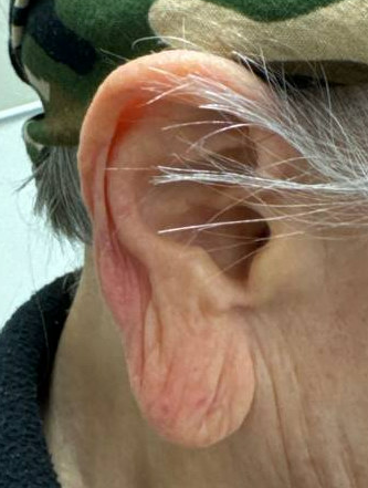 R Earlobe Reduction Before