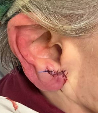 R Earlobe Reduction Sutures