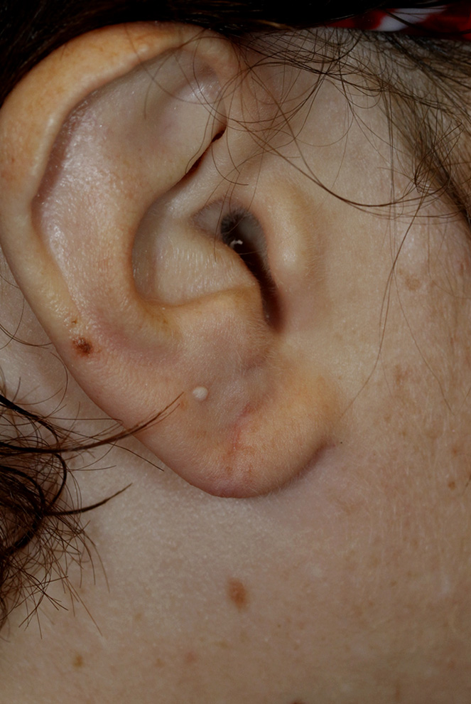 After Earlobe Tear Repair