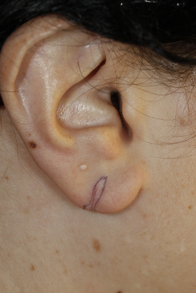 Earlobe Tear Repair Skin Marking