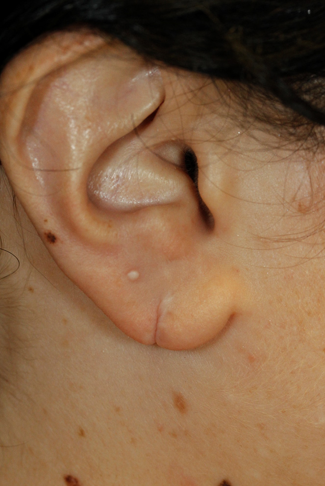 Before Earlobe Tear Repair