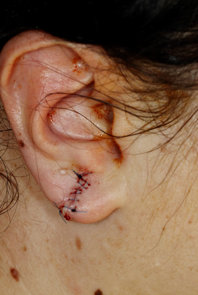 Earlobe Tear Repair With Sutures