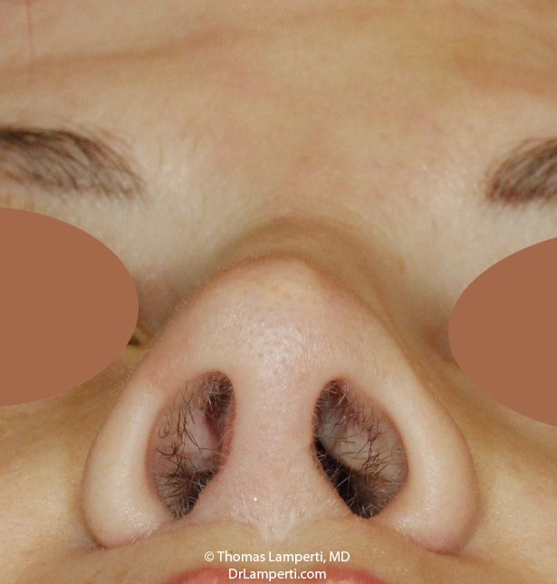 Rhinoplasty Base After