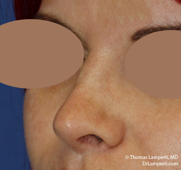 Rhinoplasty L Oblique After