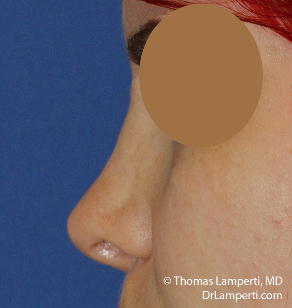 Rhinoplasty L Profile After