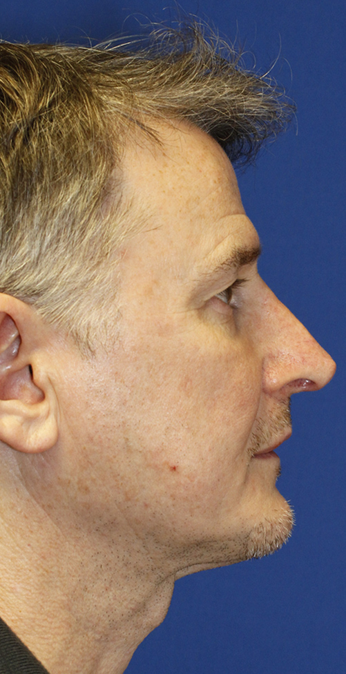 Revision rhinoplasty after profile