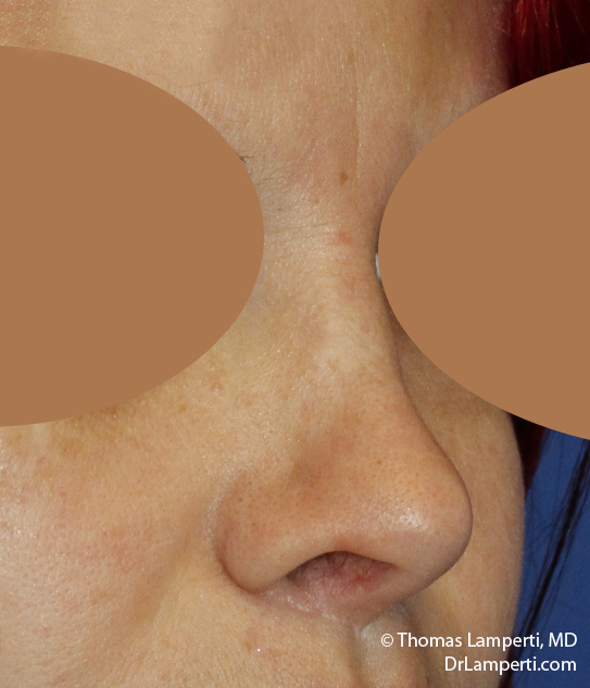 Rhinoplasty R Oblique After