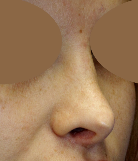 Rhinoplasty R Oblique Before