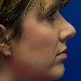 Before upturned nose rhinoplasty