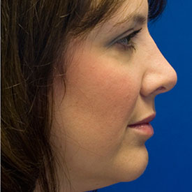 After upturned nose rhinoplasty