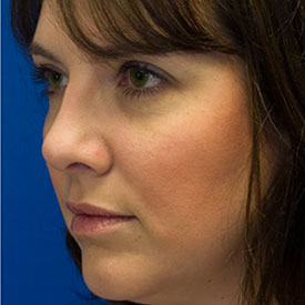 After bulbous tip rhinoplasty