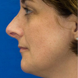 Before revision rhinoplasty photo