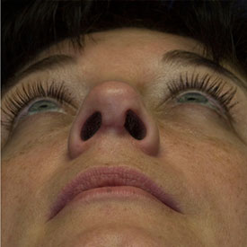 After revision rhinoplasty photo