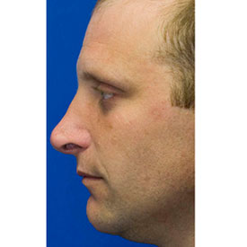 Before revision rhinoplasty photo