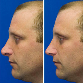 After revision rhinoplasty photo