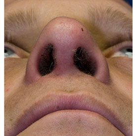 After revision rhinoplasty photo