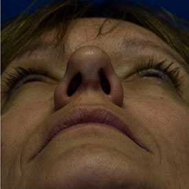 After pinched tip rhinoplasty