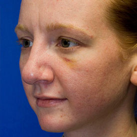 Before bulbous tip rhinoplasty